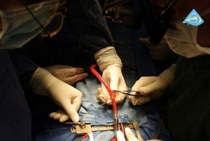 В Улан-Удэ хирурги БСМП провели операцию на работающем сердце