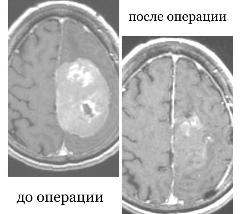 Жительница Бурятии с опухолью в мозге шесть лет отказывалась от операции