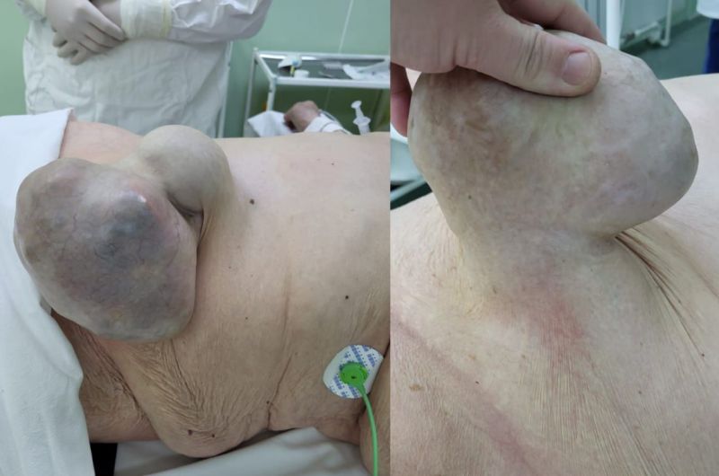 В Улан-Удэ врачи удалили 91-летней женщине гигантскую грыжу